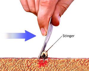 how to remove the stinger of a bee or wasp